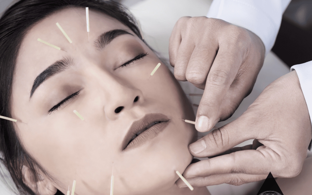 Acupuncture for Acne