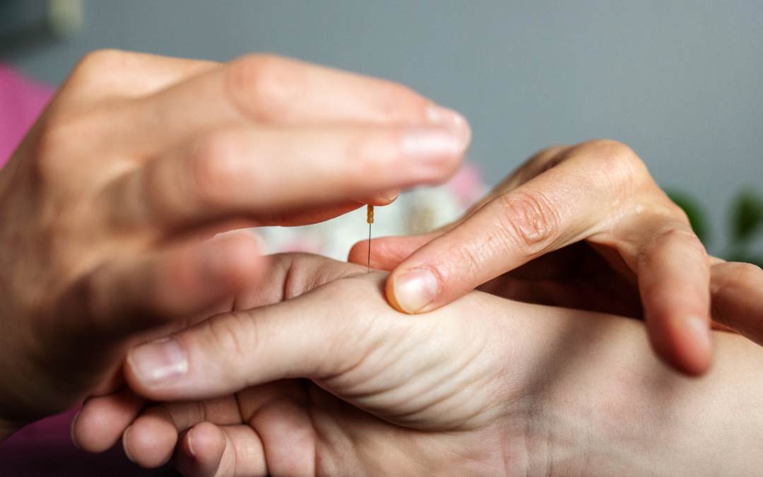 Acupuncture for pain relief in Victoria BC