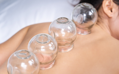 Cupping Therapy for Musculoskeletal Pain: How This Ancient Technique Can Help You Heal