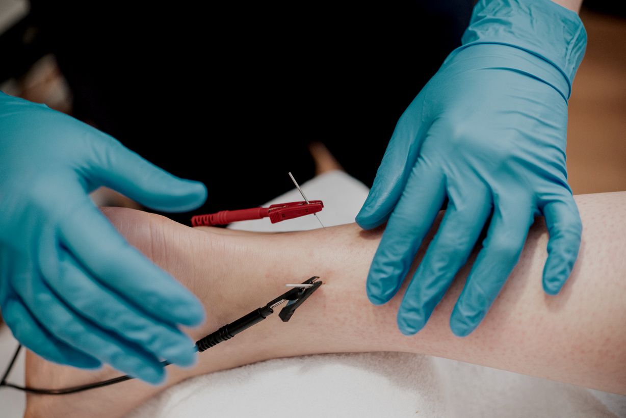 Electro-Acupuncture Victoria BC